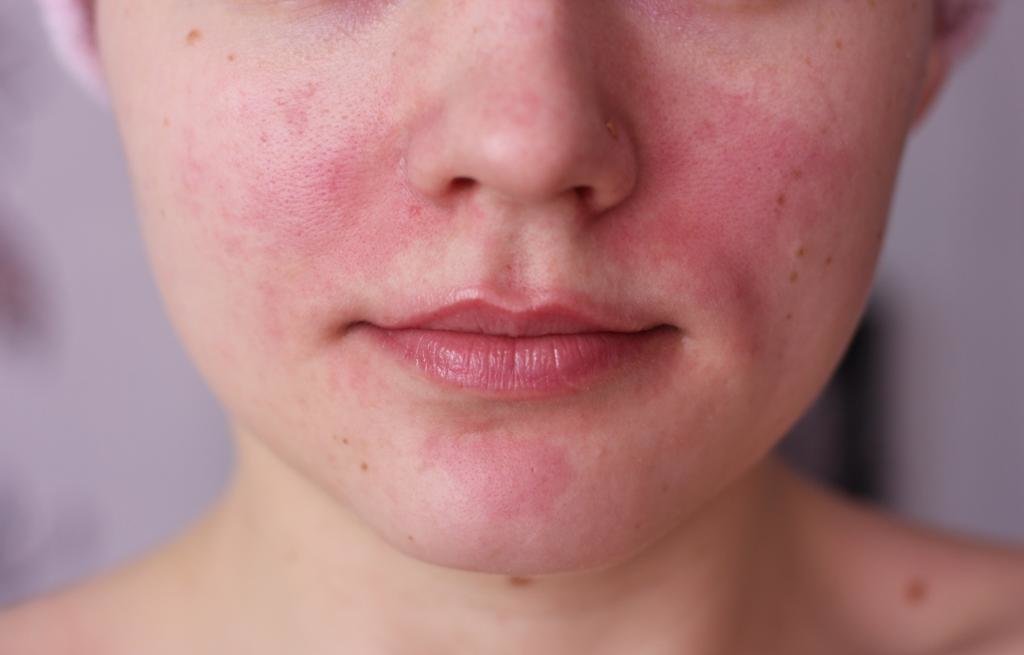 De quoi votre peau essaie-t-elle de vous avertir: les signes les plus courants О чём пытается предупредить вас ваша кожа