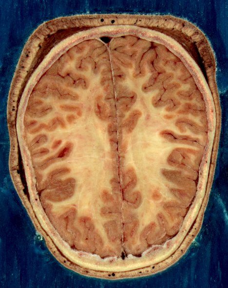 Cerveau féminin adulte dans une coupe Головной мозг взрослой женщины в разрезе