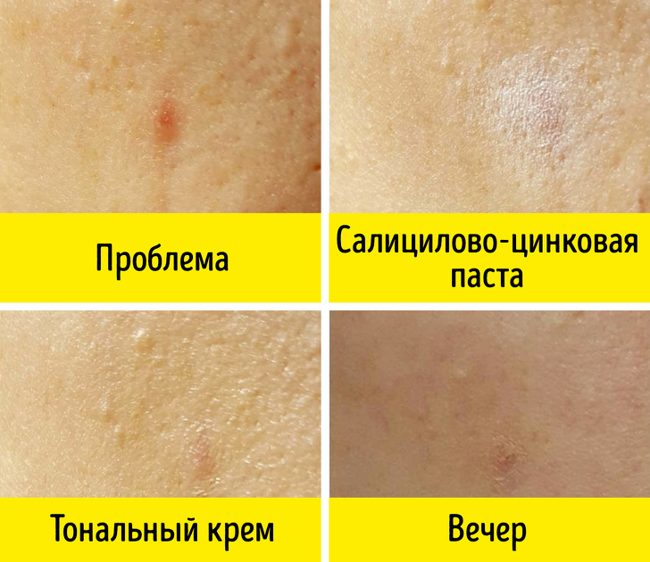 Salicylic Zinc Paste - Médicaments bon marché des pharmacies qui fonctionnent, ainsi que des cosmétiques coûteux Салицилово-цинковая паста - Бюджетные средства из аптеки, не хуже дорогой косметики