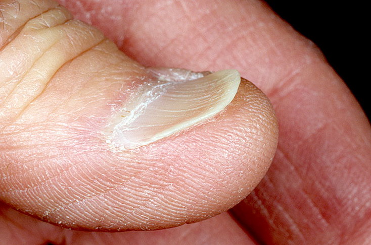 Ongles en forme de cuillère (ou coilony) Ложкообразные ногти