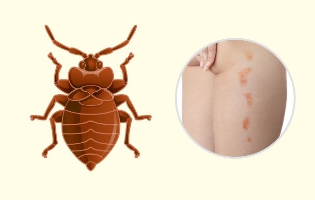 Punaise de lit - Comment reconnaître exactement quel insecte vous a mordu Клоп - Чей это укус?