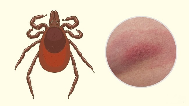 Tick - Comment reconnaître exactement quel insecte vous a mordu Клещ - Чей это укус?