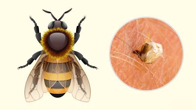 Abeille - Comment reconnaître exactement quel insecte vous a mordu Пчела - Чей это укус?