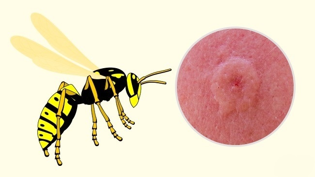 Guêpe - Comment reconnaître exactement quel insecte vous a mordu Оса - Чей это укус?