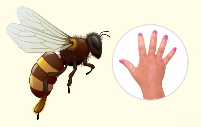 Hornet - Comment reconnaître exactement quel insecte vous a mordu Шершень - Чей это укус?