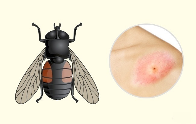 Gadfly - Comment reconnaître exactement quel insecte vous a mordu Слепень - Чей это укус?