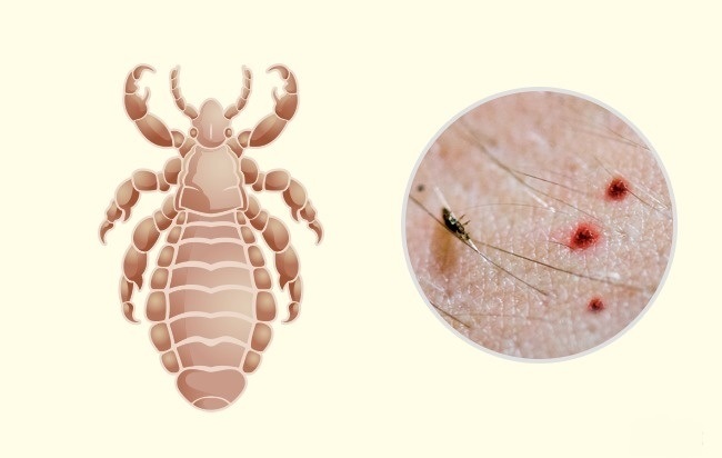 Pou - Comment reconnaître exactement quel insecte vous a mordu Вошь - Чей это укус?
