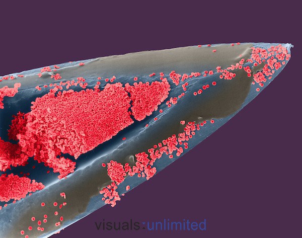 L'aiguille pour injection sous-cutanée avec des particules de sang - 30+ Photos sous le microscope Игла для подкожных инъекций с частичками крови - 30+ Фотографий под Микроскопом
