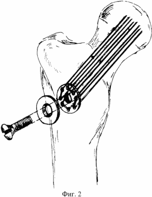 MÉTHODE DE CHIRURGIE fractures médianes de traitement de l'BONE du col du fémur