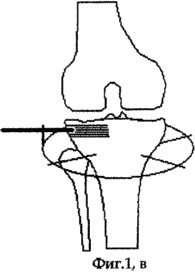 MÉTHODE DE TRAITEMENT déformation arthroses GENOU