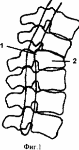MÉTHODE DE TRAITEMENT CHIRURGICAL DE FRACTURE DE CONSÉQUENCES DE LA COLONNE