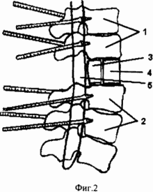 MÉTHODE DE TRAITEMENT CHIRURGICAL DE FRACTURE DE CONSÉQUENCES DE LA COLONNE