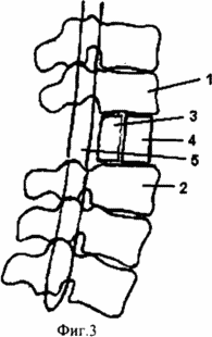 MÉTHODE DE TRAITEMENT CHIRURGICAL DE FRACTURE DE CONSÉQUENCES DE LA COLONNE