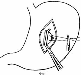 Méthode de traitement chirurgical des ulcères compliqués MUR ARRIÈRE DU VENTRE